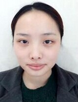 北京八大处下颌角整形来看看我的变化大不大