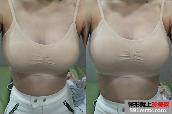 自体脂肪丰胸真实经历 上海天大自体脂肪隆胸日记