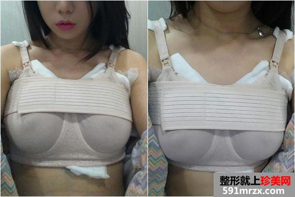 自体脂肪丰胸真实经历 上海天大自体脂肪隆胸日记