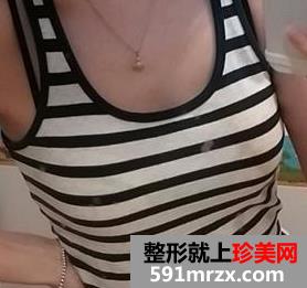 自体脂肪丰胸真实经历 上海天大自体脂肪隆胸日记