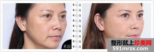 上海热玛吉除皱价格一览曝光