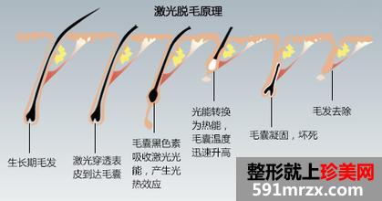 武汉激光脱毛大概要多少钱？