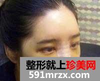 自体脂肪隆鼻术前后照片对比和案例分享