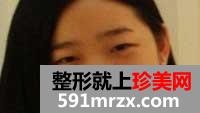 自体脂肪隆鼻术前后照片对比和案例分享