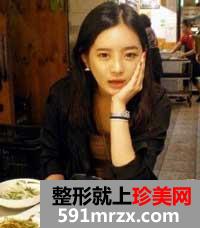 自体脂肪隆鼻术前后照片对比和案例分享