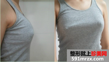 北京知音假体隆胸前后对比照