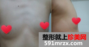 北京知音假体隆胸前后对比照