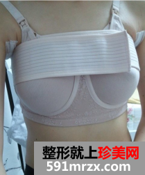 北京知音假体隆胸前后对比照