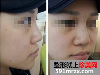 隆鼻失败后修复 效果确实不错