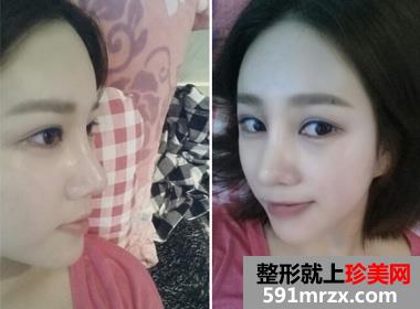 隆鼻失败后修复 效果确实不错