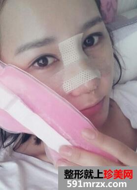 隆鼻失败后修复 效果确实不错