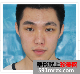 大连,微美,整形,医院,双眼皮,垫下巴,玻尿酸隆鼻,苹果肌