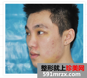 大连,微美,整形,医院,双眼皮,垫下巴,玻尿酸隆鼻,苹果肌
