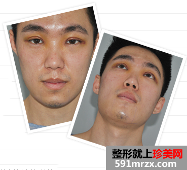 大连,微美,整形,医院,双眼皮,垫下巴,玻尿酸隆鼻,苹果肌