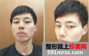 面部综合整形+软骨隆鼻3个月恢复纪实