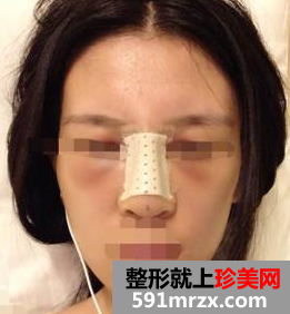 硅胶隆鼻+耳软骨垫鼻尖效果图分享
