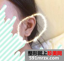 硅胶隆鼻+耳软骨垫鼻尖效果图分享