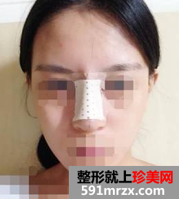 硅胶隆鼻+耳软骨垫鼻尖效果图分享