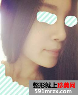 硅胶隆鼻+耳软骨垫鼻尖效果图分享
