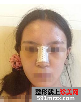 硅胶隆鼻+耳软骨垫鼻尖效果图分享