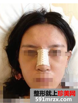 硅胶隆鼻+耳软骨垫鼻尖效果图分享