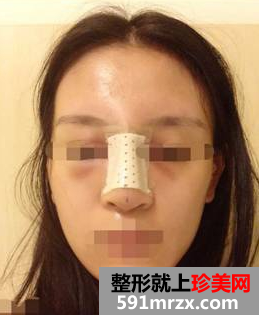 硅胶隆鼻+耳软骨垫鼻尖效果图分享