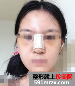 硅胶隆鼻+耳软骨垫鼻尖效果图分享