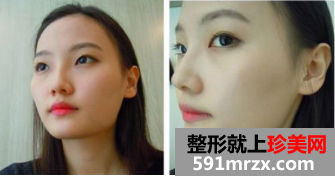 上海九院下颌角整形效果怎么样 上海九院下颌角案例！