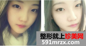 上海九院下颌角整形效果怎么样 上海九院下颌角案例！