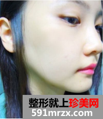 上海九院下颌角整形效果怎么样 上海九院下颌角案例！