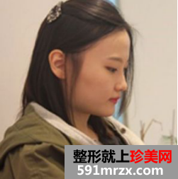 上海九院下颌角整形效果怎么样 上海九院下颌角案例！