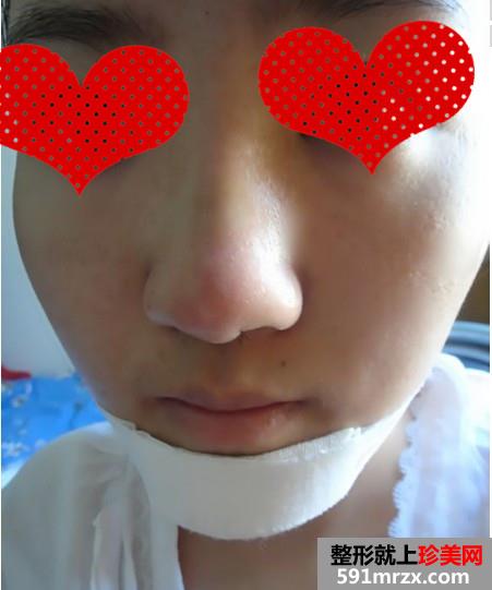 隆鼻整形+垫下巴让我丑小鸭变大美人