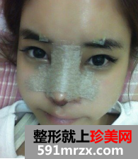 硅胶隆鼻+自体脂肪移植 那效果来说话