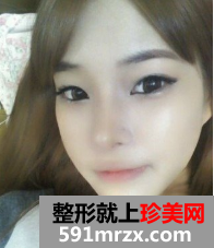 硅胶隆鼻+自体脂肪移植 那效果来说话