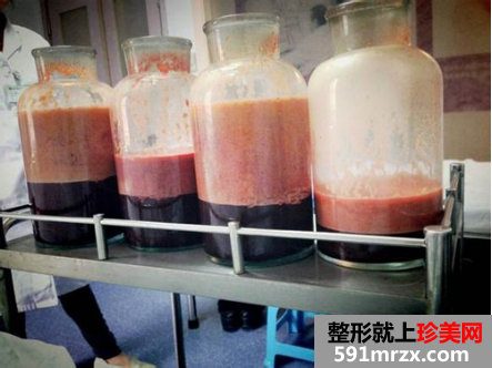 福建华美整形做完大腿吸脂后的一些恢复图