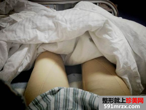 福建华美整形做完大腿吸脂后的一些恢复图