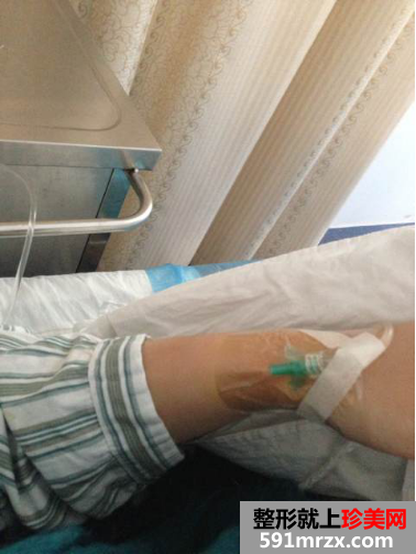 福建华美整形做完大腿吸脂后的一些恢复图