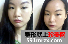 双眼皮恢复过程图片 双眼皮恢复过程记录
