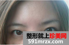 去眼袋术后恢复日记