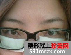 去眼袋术后恢复日记