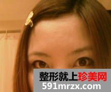 去眼袋术后恢复日记