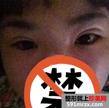双眼皮修复术这次成功了，美到极至~