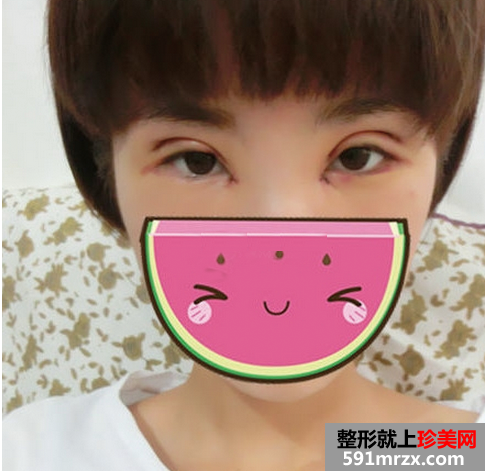 双眼皮修复术这次成功了，美到极至~