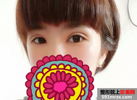 双眼皮修复术这次成功了，美到极至~