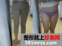 大腿吸脂真实案例 4个月恢复经历分享