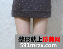 大腿吸脂真实案例 4个月恢复经历分享