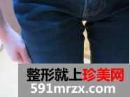 大腿吸脂真实案例 4个月恢复经历分享