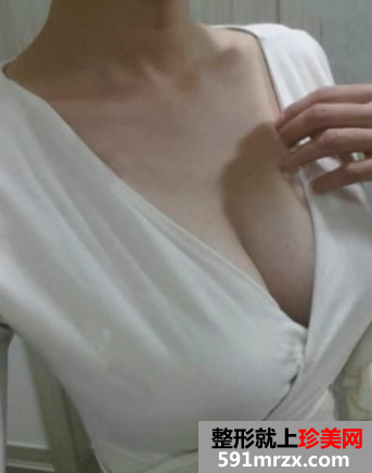 假体隆胸术后效果对比