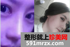 隆鼻割双眼皮恢复图 2个月恢复经历分享