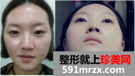 隆鼻割双眼皮恢复图 2个月恢复经历分享